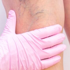 Příznaky křečových žil